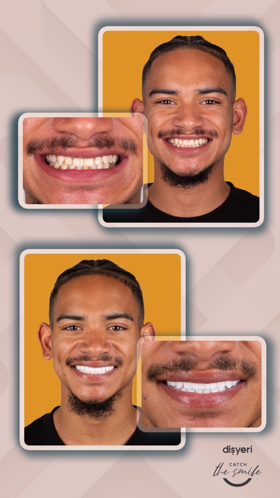 Smile transformation before and after 1