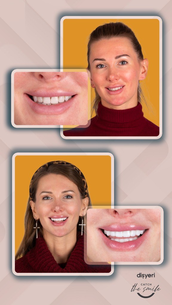 Smile transformation before and after 2