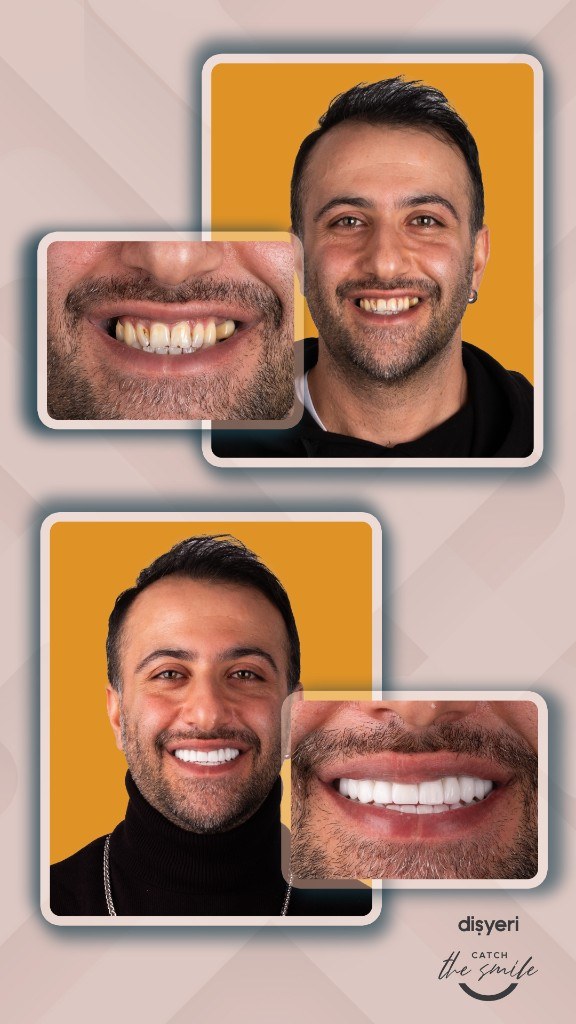 Smile transformation before and after 3