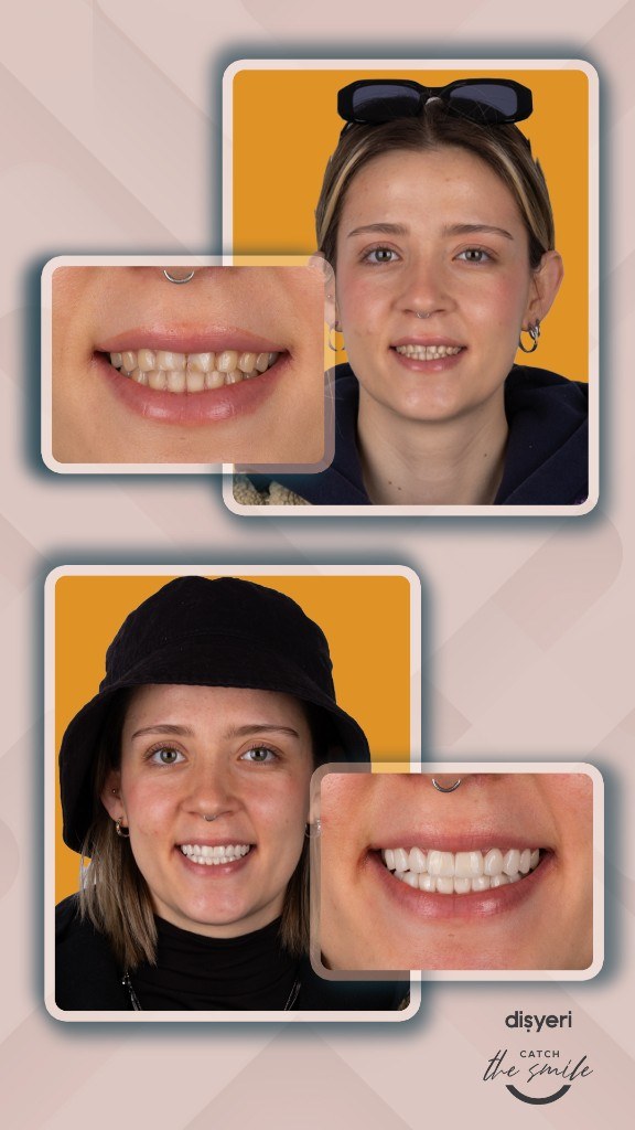 Smile transformation before and after 4 ans
