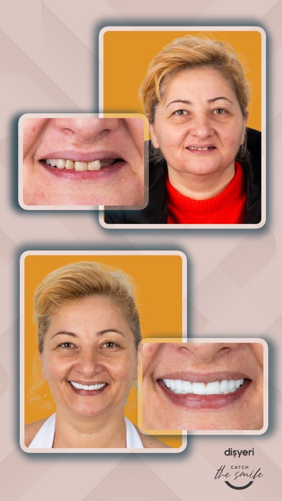 Smile transformation before and after 5 ans