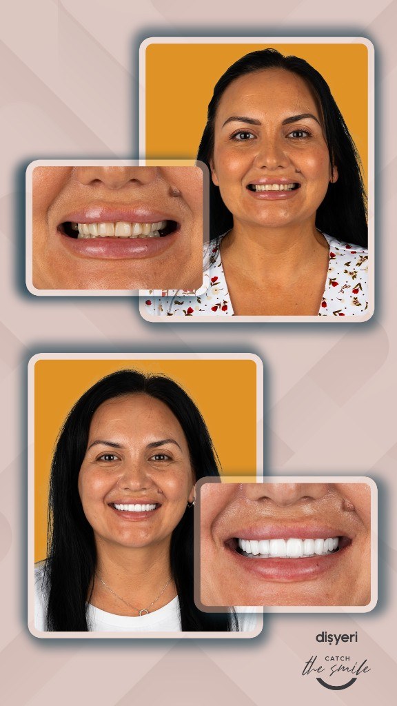 Smile transformation before and after 6 ans