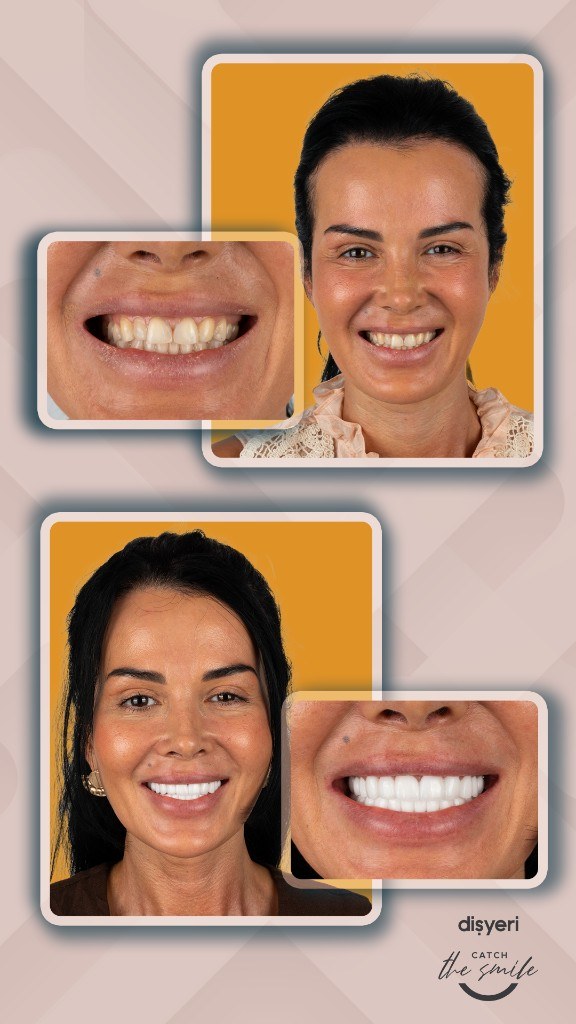 Smile transformation before and after 7 ans