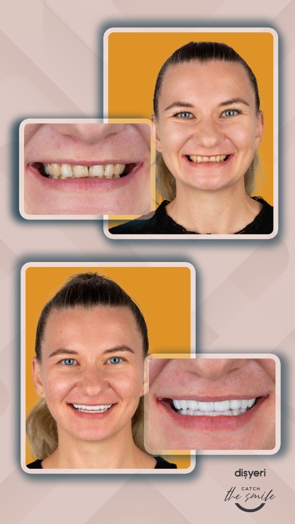 Smile transformation before and after 8 ans