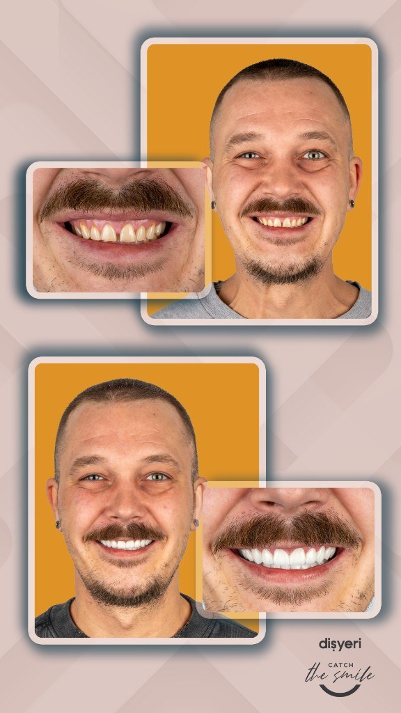 Smile transformation before and after 9 heures