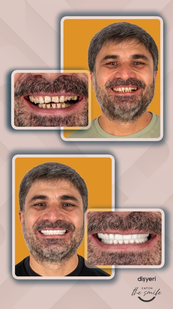 Smile transformation before and after 10 heures
