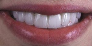 Teeth Whitening